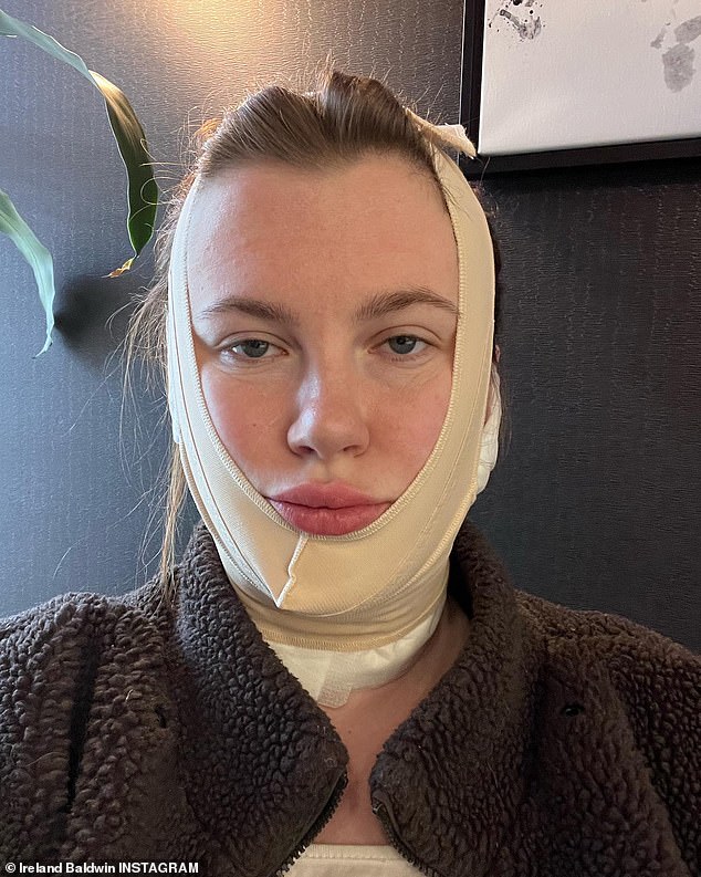 İyileşme: 26 yaşındaki model, Salı öğleden sonra yayınlanan yeni bir Instagram videosunda, FaceTite'ın anestezi bile gerektirmeyen, minimal düzeyde invaziv, bir saat süren ofis içi bir prosedür olduğunu açıkladı.